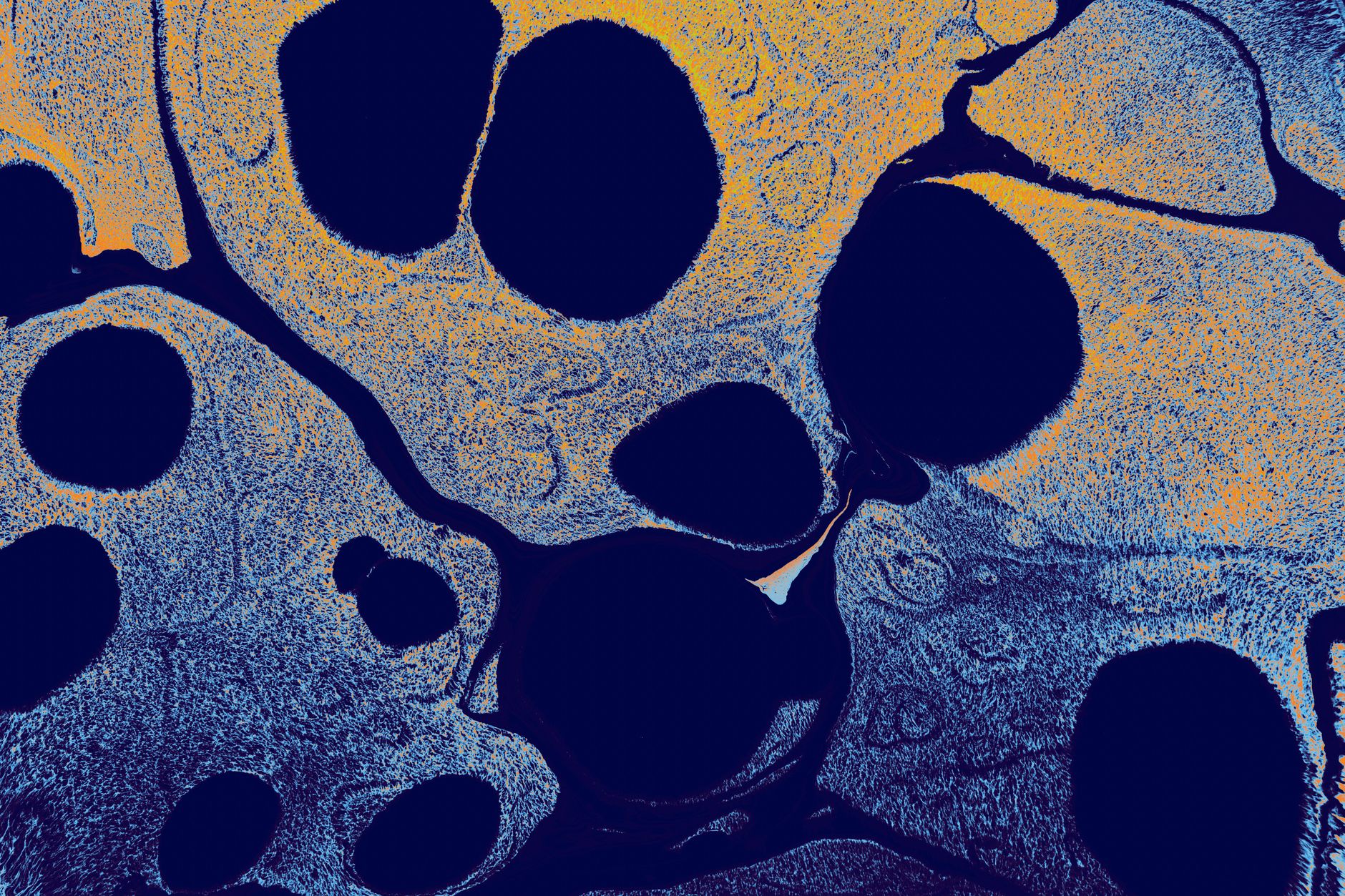 Clonal Evolution in Follicular Lymphoma