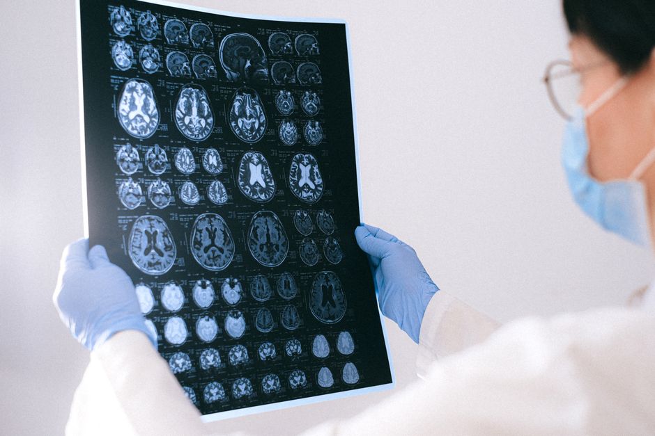 German Registry of Alzheimer's Disease Treated With Transcranial Pulse Stimulation