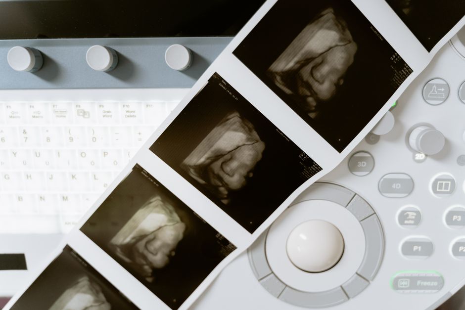Early Labor Pre-Marking for Epidural Analgesia: Ultrasound vs Manual Palpation
